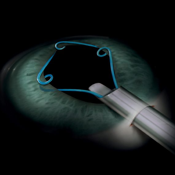 Malyugin Ring<sup>®</sup>